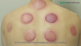 What You Need to Know about Cupping [upl. by Corly]