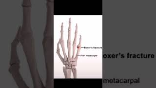 Boxers fracture  Boxer’s fracture is a break in the neck of the 5th metacarpal bone in the hand [upl. by Tuchman]