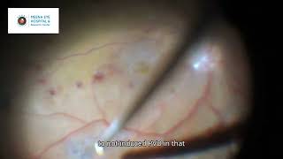 Diabetic Vitrectomy  ILM peeling  Epiretinal Membrane  Dr Ashish K Jain  MEHRC Mumbai [upl. by Nicolau]