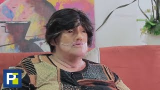 El desgarrador testimonio de una mujer que perdió su rostro a causa de un accidente [upl. by Reniar]