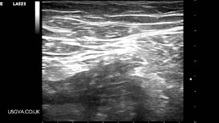 Ultrasound Guided Femoral Nerve Block [upl. by Sidnal]