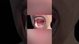 Tonsillitis medicalanimation health [upl. by Annair]