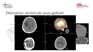 Hémorragie intraventriculaire chez le prématuré Point sur la prise en charge DR Andrés Coca [upl. by Luke276]