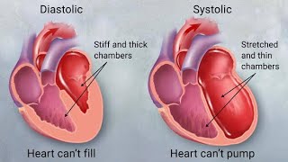 Differences between Systolic heart failure and Diastolic Heart Failure [upl. by Volotta]