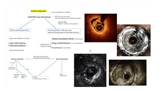 DES instent restenosis mechanisms and interventional management Elias Hanna [upl. by Einaoj711]