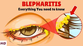 Blepharitis – Causes Signs and Symptoms Home Remedies amp Treatment [upl. by Pizor]