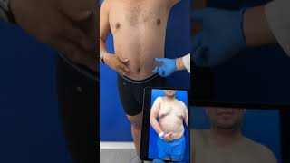 Postoperatorio lipoabdominoplastia masculina [upl. by Prentice]