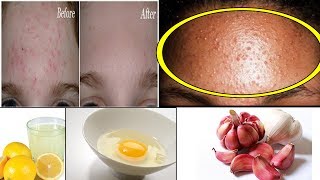 6 Best Ways To Get Rid Of Bumps On Forehead [upl. by Darahs]