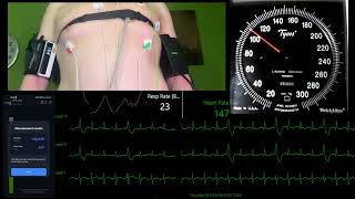 Fast Tachycardia beats while Standing w Breathholding ECG 2x Blood Pressure Cuff [upl. by Custer212]