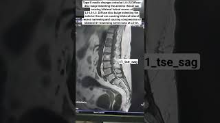 MRI Spine Showing Diffuse disc bulge t1tsesag Sequence beginners [upl. by Akinom]