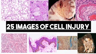 25 Images From Cell Injury  Part 01  Made Easy [upl. by Ennahtebazile633]