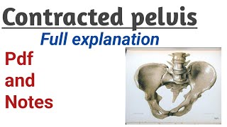 Contracted pelvis causes  symptoms and management [upl. by Haslam]