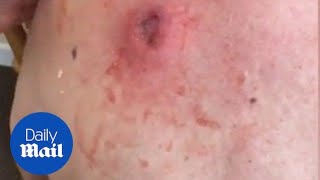 Gross moment a 25yearold cyst is popped and oozes pus [upl. by Neicul]