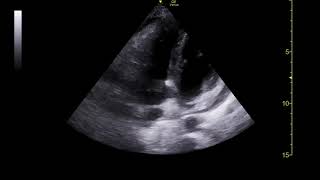 Tricuspid Valve Infective Endocarditis [upl. by Dorise]