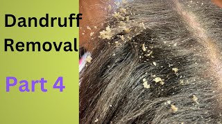 Dandruff Removal Part 4  Huge Flakes [upl. by Oibirot]