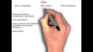 Aneurysm  Saccular Aneurysm  neurology 87  First Aid USMLE Step 1 in UrduHindi [upl. by Ahtanamas]