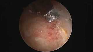 Hip Labral Tear debridement and Repair [upl. by Thalia]