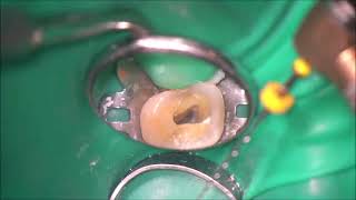 treatment of failed pulpotomized tooth using FQ system [upl. by Ennire]