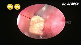 CASE NO 07  WHATS THIS THING INSIDE NOSE 😮  F B REMOVAL  NASAL ENDOSCOPY [upl. by Neemsaj50]