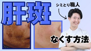 【消せないシミはない！】肝斑（かんぱん）の治療法を日本一の美容家が教えます [upl. by Oicnecserc524]