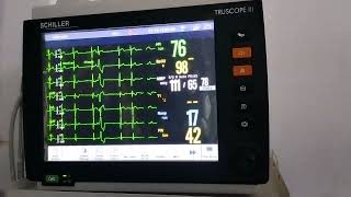 case of Ventricular Bigeminy changing to Trigeminy and Quadrigeminy [upl. by Hardej]