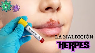 Herpes y cómo se propaga Tratamiento y prevención herpeszoster enfermedades síntomas [upl. by Draneb]