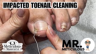 How to Fix Ingrown  Impacted Toenails at Home nails satisfying [upl. by Nevi]