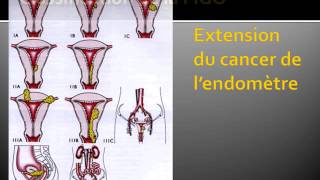 GYNECOLOGIE Cancer de l’endomètre 3 [upl. by Broida]