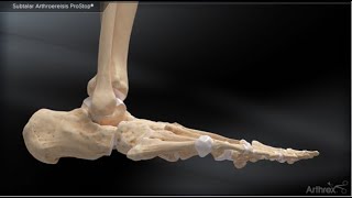 Subtalar Arthroereisis ProStop® [upl. by Sinylg]