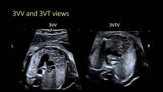 Fetal Echocardiography The 3VTV and identifying arch abnormalities [upl. by Mouldon]