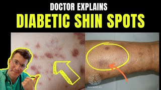 Doctor explains DIABETIC DERMOPATHY AKA DIABETIC SHIN SPOTS – plus causes and prevention [upl. by Zysk]