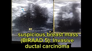 ultrasound of suspicious breast mass BIRAD 5 Invasive ductal carcinoma [upl. by Charbonnier292]