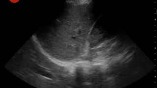 SS Video 21 Normal hemithorax [upl. by Culberson]