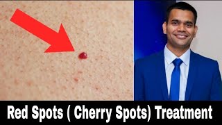 Red Skin Dots  cherry Angioma  Natural Treatment  Dr Vivek Joshi [upl. by Yelahs]