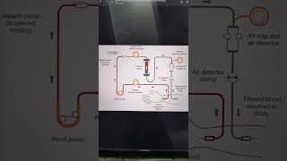 hemodialysis abvmubscnursing bscnursingsyllabus nursingdegree msn sem4 [upl. by Erich607]