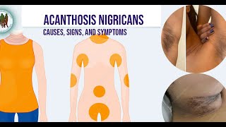 Acanthosis Nigricans Causes Signs and Symptoms [upl. by Correy]