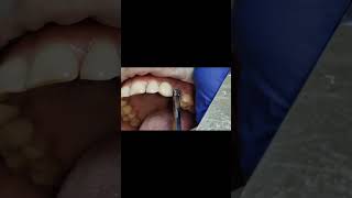 2 implants for single premolar replacement tapping test after 1 year shorts [upl. by Fates274]