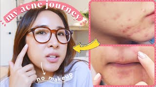 How I CLEARED my hormonal acne NATURALLY  730 day plan you can try [upl. by Ailuig113]