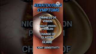 KERATOCONUS  TREATMENT keratoconus KERATOCONUSTREATMENT [upl. by Anoirtac645]