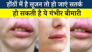 Angioedema cause and treatment होठों और आंखों की सूजन का इलाज [upl. by Ariait400]