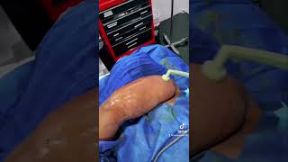 BodyTite Arm Liposuction  Live Surgery by Dr Christopher Chia  Plastic Surgery in Manhattan NYC [upl. by Adiehsar]