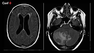 Cas dimagerie lésion focale hémisphérique cérébelleuse droite avec oedème périlésionnel [upl. by Kcaj]