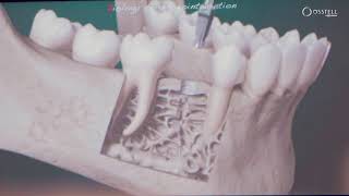 Biological process of osseointegration [upl. by Ahseiym156]