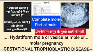 Molar pregnancy  Hydatiform mole kya होती है प्रेगनेंसी में अंगूर के गुच्छे वाली बीमारी GTD [upl. by Orose]