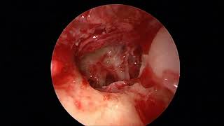 Endoscopic Transcanal Excision of Otic Capsule Schwannoma [upl. by Hekking]