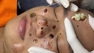 blackheads new 2023  popping pimple today  blackheads and whiteheads removal [upl. by Tull]