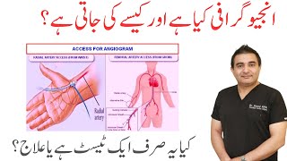 What is Angiography  Ye sirf ek Test hai Yaa Treatment  Dr Saeed Afridi [upl. by Saraiya]