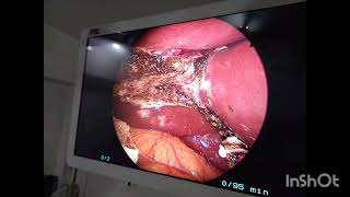 mucocele of Gall bladder due to stone Laparoscopic operation [upl. by Nosna]