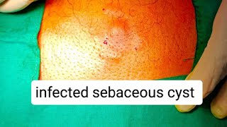 infected sebaceous cyst  incision and drainage  abscess  dr youtube [upl. by Ttcos711]