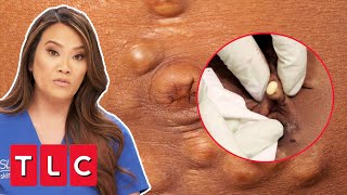 Woman Has Over 500 “PEBBLE” Bumps All Over Her Body  Dr Pimple Popper This Is Zit [upl. by Olsewski933]